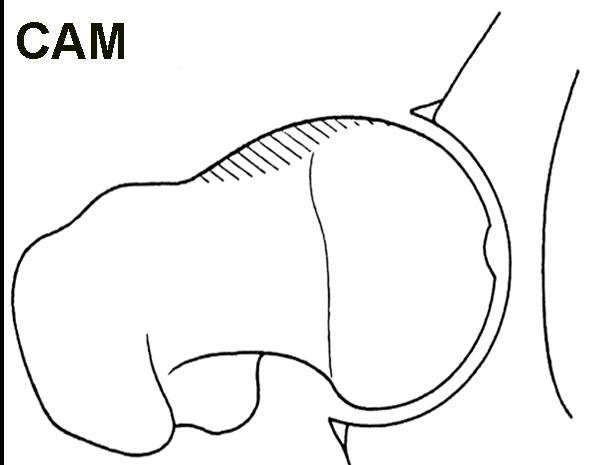 2d diagram of cam lesion