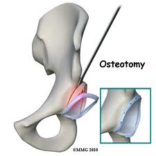 Acetabular rim osteotomy and labral reattachement