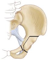 Periarticular realignment osteotomy